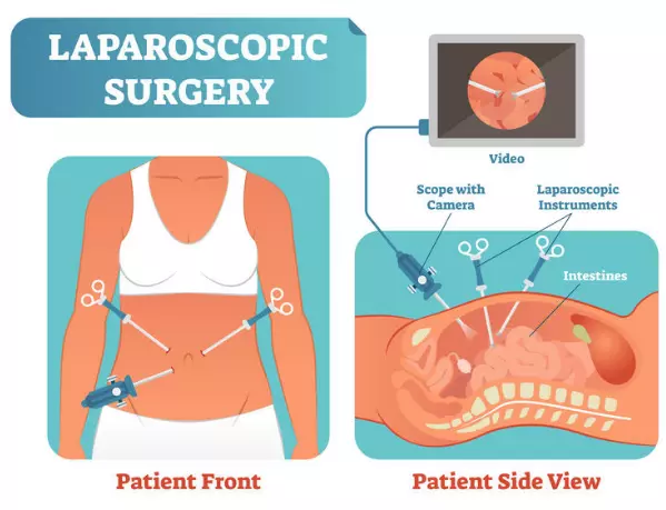 Diagram of a laparoscopic surgery showing the steps a urologist might take and where the procedure takes place on the body.