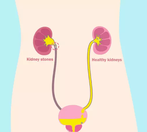 Pazona MD Graphic of Kidney Stone blockage versus Kidney Without blockage